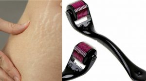 استخدام الديرما رولر لعلاج الخطوط البيضاء