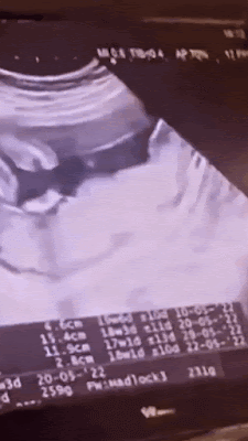 حركة الجنين في الشهر الرابع حركة الجنين في الشهر الرابع