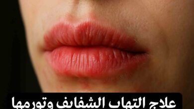 علاج التهاب الشفايف من الخارج