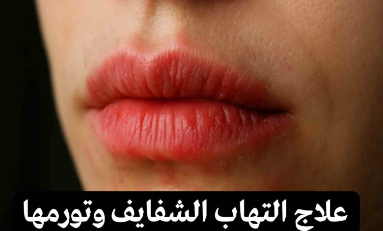 علاج التهاب الشفايف من الخارج