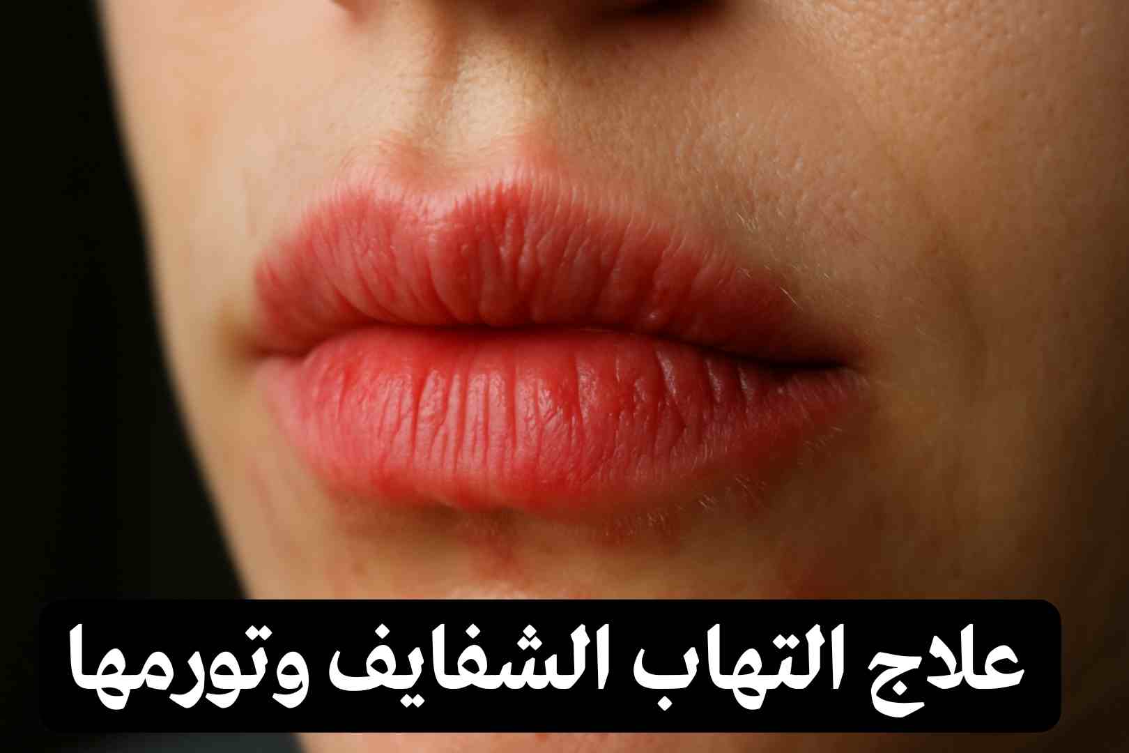 علاج التهاب الشفايف من الخارج